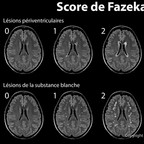 Classification de Fazekas pour la leucoaraïose (ARWMC) score-de-fazekas-leucoaraiose-IRM Classification de Fazekas pour la leucoaraïose (ARWMC) score-de-fazekas-leucoaraiose-IRM