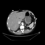 Embolie pulmonaire proximale avec coeur droit 1_2_840_113619_2_55_3_511181086_393_1340961135_849_3_MONOCHROME2_512x512_0_921875_0_921875 Embolie pulmonaire proximale avec coeur droit 1_2_840_113619_2_55_3_511181086_393_1340961135_849_3_MONOCHROME2_512x512_0_921875_0_921875