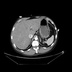 Embolie pulmonaire proximale avec coeur droit 1_2_840_113619_2_55_3_511181086_393_1340961135_849_3_MONOCHROME2_512x512_0_921875_0_921875
