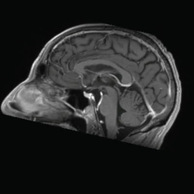 Schwannome cochléovestibulaire (neurinome de l'acoustique) T1 3D GADO AXIAL_MPR_Sag