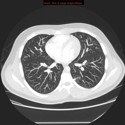 Hereditary hemorrhagic telangiectasia with lung arteriovenous malformation  CT Thorax MIP