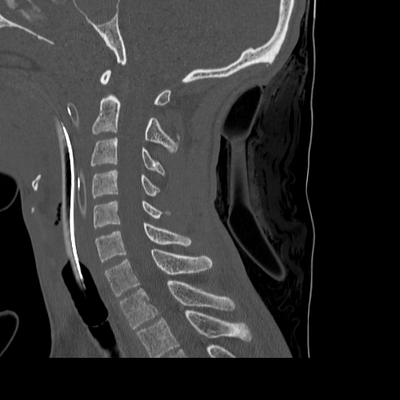 Craniocerebral trauma, Pulmonary edema, Renal injury Cervical spine, Sagittal plane, Bone window