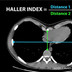 Pectus excavatum Haller-index-Pectus-excavatum