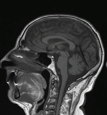 Schwannome cochléovestibulaire (neurinome de l'acoustique) T1 SE SAG