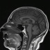 Schwannome cochléovestibulaire (neurinome de l'acoustique) T1 SE SAG