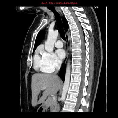 Veine cave supérieure gauche et retour veineux pulmonaire anormal partiel  TDM Thorax Sagittal