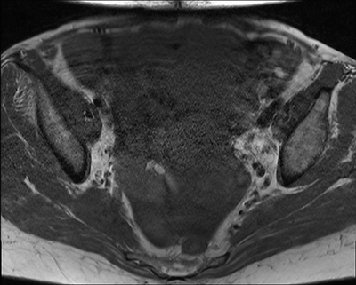 Cystadénocarcinome ovarien séro-papillaire moyennement différencié Stade IIIb Axial T1