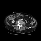 Cancer du colon perforé avec abcès au contact TDM Abdomen Axial Temps veineux Cancer du colon perforé avec abcès au contact TDM Abdomen Axial Temps veineux