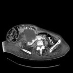Hernie de Spiegel responsable d'une dilatation des voies biliaires et urinaires. TDM Abdomen Axial Temps veineux Hernie de Spiegel responsable d'une dilatation des voies biliaires et urinaires. TDM Abdomen Axial Temps veineux
