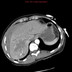 Embolisation hépatique d'un hématome post-traumatique  TDM Thorax Abdomen Axial Temps artériel