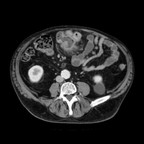 Patient traité par radiothérapie pour cancer prostatique. TDM Abdomen Axial Temps veineux Patient traité par radiothérapie pour cancer prostatique. TDM Abdomen Axial Temps veineux
