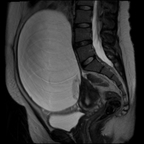 Adénocarcinome invasif mixte ovarien droit Sagittal T2 Adénocarcinome invasif mixte ovarien droit Sagittal T2