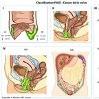 Cancer de la vulve FIGO-Classification-cancer-vulve Cancer de la vulve FIGO-Classification-cancer-vulve