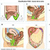Cancer de la vulve FIGO-Classification-cancer-vulve