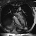 Thrombus sur infactus du myocarde apical Cine-IRM 4 cavités Thrombus sur infactus du myocarde apical Cine-IRM 4 cavités