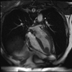 Thrombus sur infactus du myocarde apical Cine-IRM 4 cavités