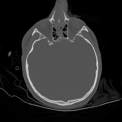 Craniocerebral trauma, Pulmonary edema, Renal injury Head CT, Axial plane, Bone window
