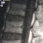 Forme rare d'une hernie discale lombaire image 1 Forme rare d'une hernie discale lombaire image 1