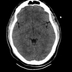 Traumatic diaphragmatic rupture, Thoracic and abdominal injuries, burst vertebral fracture, foot injuries Head CT, Axial plane, Soft tissue window Traumatic diaphragmatic rupture, Thoracic and abdominal injuries, burst vertebral fracture, foot injuries Head CT, Axial plane, Soft tissue window