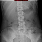 colique néphrétique droite sur calcul du méat urétéral Radiographie Abdomen Pelvis colique néphrétique droite sur calcul du méat urétéral Radiographie Abdomen Pelvis