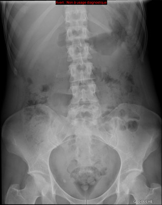 colique néphrétique droite sur calcul du méat urétéral  Radiographie Abdomen Pelvis