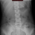 colique néphrétique droite sur calcul du méat urétéral  Radiographie Abdomen Pelvis