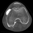 Rupture de la ligamentoplastie croisée antérieure Axial Rupture de la ligamentoplastie croisée antérieure Axial