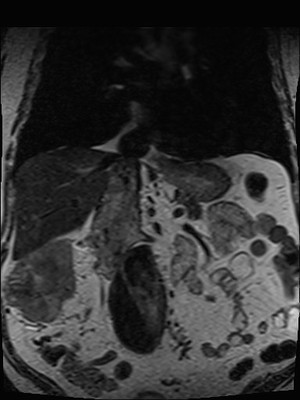 Adénocarcinome rénal droit avec envahissement de la veine rénale et de la VCI T2 coronal