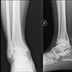 Arthropathie talo-crurale grade IV sur son versant médial et sous-talienne postéro-latérale dans son versant latéral secondaire à une rupture complète ancienne des faisceaux antérieurs et moyens du ligament collatéral latéral Radiographie Cheville 1