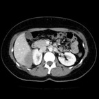 Métastases hépatiques d'un adénocarcinome thymique. TDM Abdomen Axial Temps veineux Métastases hépatiques d'un adénocarcinome thymique. TDM Abdomen Axial Temps veineux