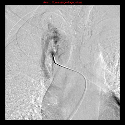 Hereditary hemorrhagic telangiectasia with lung arteriovenous malformation Selective angiography