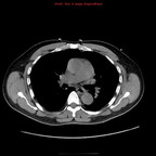 Hématome disséquant de l'aorte thoracique TDM Thorax Axial sans injection Hématome disséquant de l'aorte thoracique TDM Thorax Axial sans injection