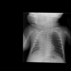 Kyste bronchogénique Radiographie de thorax Kyste bronchogénique Radiographie de thorax