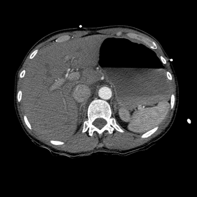 Traumatic perforation of small intestine, fracture of lumbar vertebra Chest, Abdomen and Pelvis, Arterial phase, Axial plane