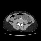 Occlusion mécanique du grêle sur diverticule de Meckel TDM Abdomen Axial Temps veineux Occlusion mécanique du grêle sur diverticule de Meckel TDM Abdomen Axial Temps veineux