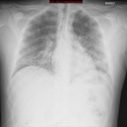 Pneumopathie varicelleuse Radiographie Thorax Face Pneumopathie varicelleuse Radiographie Thorax Face