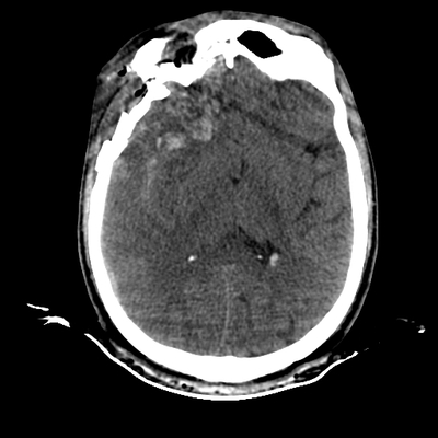 Severe cranioencephalic injuries, Carotid artery dissection, Aspiration pneumonia, Pelvic fracture Head CT, Axial plane, Soft tissue window