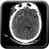 Severe cranioencephalic injuries, Carotid artery dissection, Aspiration pneumonia, Pelvic fracture Head CT, Axial plane, Soft tissue window