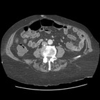 Ulcère gastrique de la grande courbure avec pneumopéritoine. TDM Abdomen Pelvis Axial temps portal Ulcère gastrique de la grande courbure avec pneumopéritoine. TDM Abdomen Pelvis Axial temps portal
