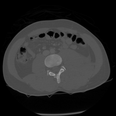 Thoracic Injuries, Spinal Injuries L5, Traumatic disc herniation Abdomen CT, Axial plane, Bone window