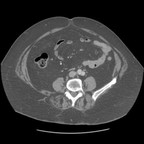 Sigmoidite diverticulaire avec abcès péri sigmoidien. TDM Abdomen Axial Temps veineux Sigmoidite diverticulaire avec abcès péri sigmoidien. TDM Abdomen Axial Temps veineux