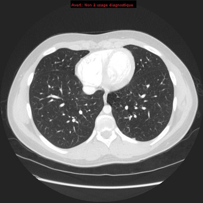 Hereditary hemorrhagic telangiectasia with lung arteriovenous malformation  CT Thorax Axial Air window