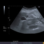 Pancréatite aigue à lipasémie normale Echographie abdominale Pancréatite aigue à lipasémie normale Echographie abdominale
