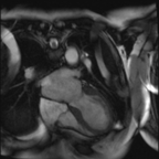 Syndrome de Tako-Tsubo - Myocardite adrénergique Cine-IRM bSSFP 4 cavités Syndrome de Tako-Tsubo - Myocardite adrénergique Cine-IRM bSSFP 4 cavités