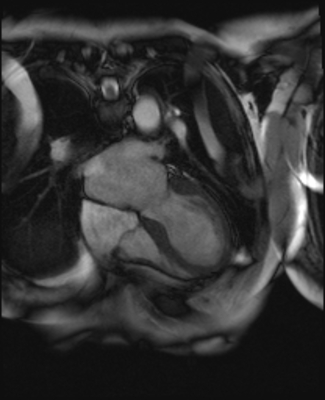 Syndrome de Tako-Tsubo - Myocardite adrénergique Cine-IRM bSSFP 4 cavités