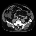 Adénocarcinome du grele. TDM Abdomen Axial Temps veineux Adénocarcinome du grele. TDM Abdomen Axial Temps veineux
