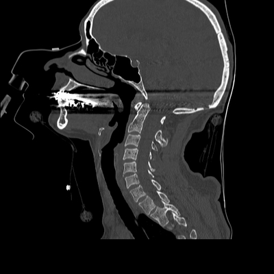 Traumatic perforation of small intestine, fracture of lumbar vertebra Cervical spine, Sagittal plane, Bone window