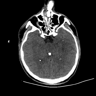 Craniocerebral trauma, Pulmonary edema, Renal injury Head CT, Axial plane, Soft tissue window