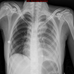 Hémothorax sur fissuration dans la cavité pleurale d'un anévrisme de l'aorte thoracique descendante Radiographie Thorax face-couchée Hémothorax sur fissuration dans la cavité pleurale d'un anévrisme de l'aorte thoracique descendante Radiographie Thorax face-couchée