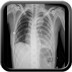 Hémothorax sur fissuration dans la cavité pleurale d'un anévrisme de l'aorte thoracique descendante  Radiographie Thorax face-couchée